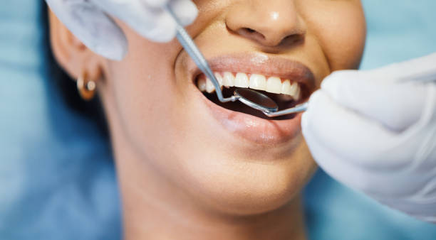 Best Lost Filling or Crown Replacement in North Patchogue, NY